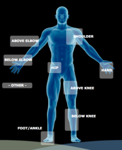 above elbow prosthetics, below elbow prosthetics, above knee prosthetics, prosthetic arm